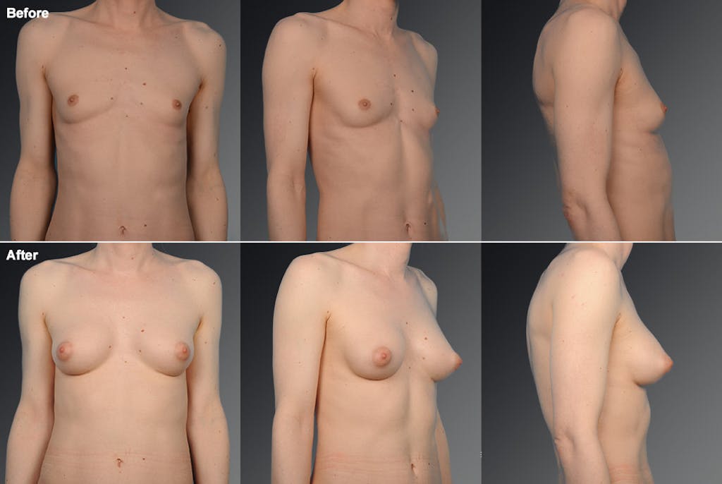 mtf transition nude MTF Top Surgery Los Angeles | Transgender Breast Augmentation