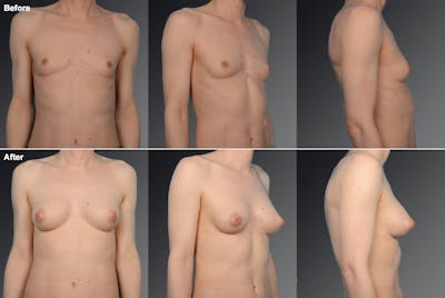 MTF Top Surgery/Transgender Before & After Gallery - Patient 105492556 - Image 1