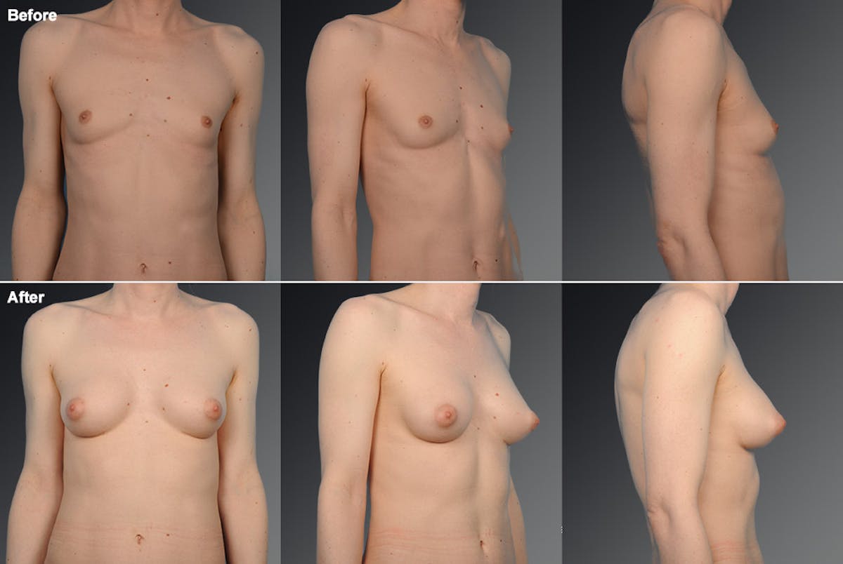 MTF Top Surgery/Transgender Before & After Gallery - Patient 105492556 - Image 1