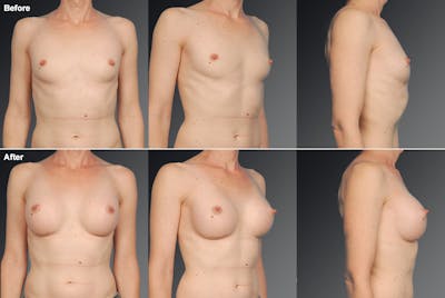 MTF Top Surgery/Transgender Before & After Gallery - Patient 105492560 - Image 1