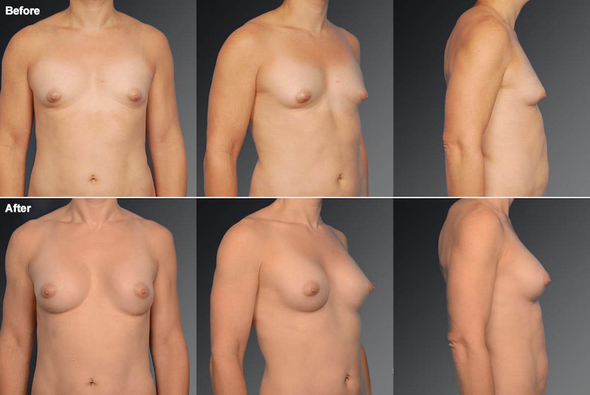 MTF Top Surgery/Transgender Before & After Gallery - Patient 105492561 - Image 1