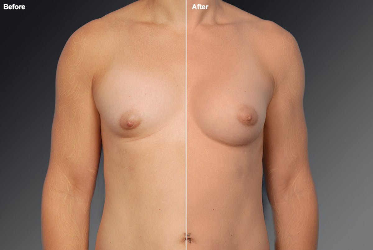 MTF Top Surgery/Transgender Before & After Gallery - Patient 105492562 - Image 1