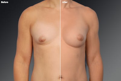 MTF Top Surgery/Transgender Before & After Gallery - Patient 105492562 - Image 1