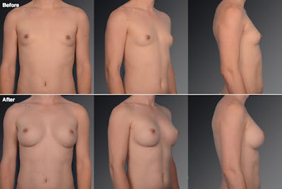 MTF Top Surgery/Transgender Before & After Gallery - Patient 105492564 - Image 1