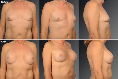 MTF Top Surgery/Transgender Before & After Gallery - Patient 105492573 - Image 1