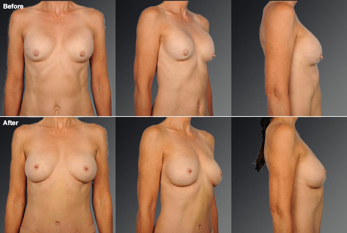 Breast Implant Revision Before & After Gallery - Patient 105516246 - Image 1
