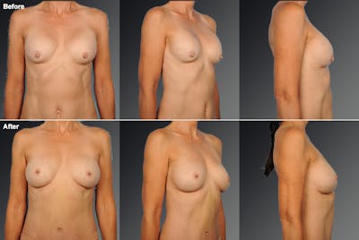 Breast Implant Revision Before & After Gallery - Patient 105516246 - Image 1