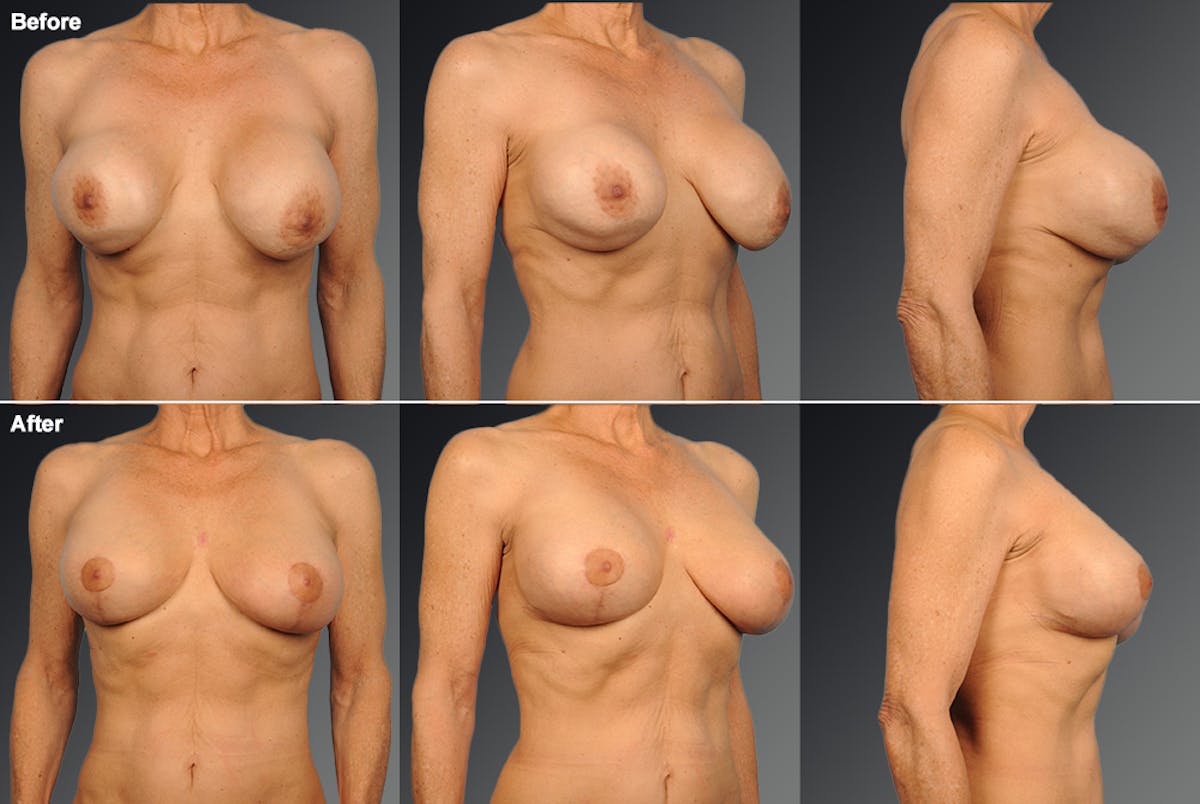 Breast Implant Revision Before & After Gallery - Patient 105516247 - Image 1