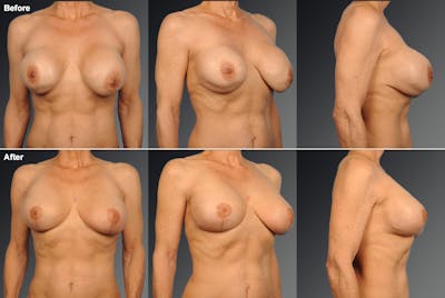 Breast Implant Revision Before & After Gallery - Patient 105516247 - Image 1