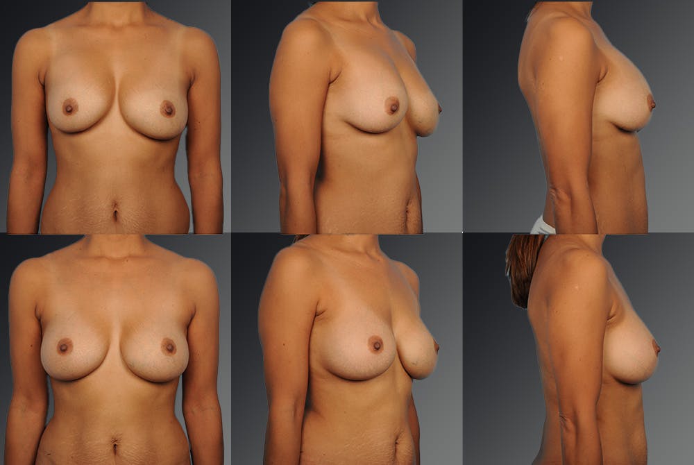 Breast Implant Revision Before & After Gallery - Patient 105516249 - Image 1