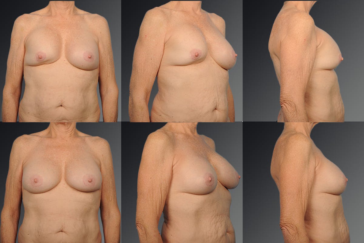 Breast Implant Revision Before & After Gallery - Patient 105516250 - Image 1