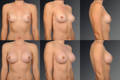Breast Implant Revision Before & After Gallery - Patient 105516262 - Image 1