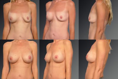 Breast Implant Revision Before & After Gallery - Patient 105516264 - Image 1