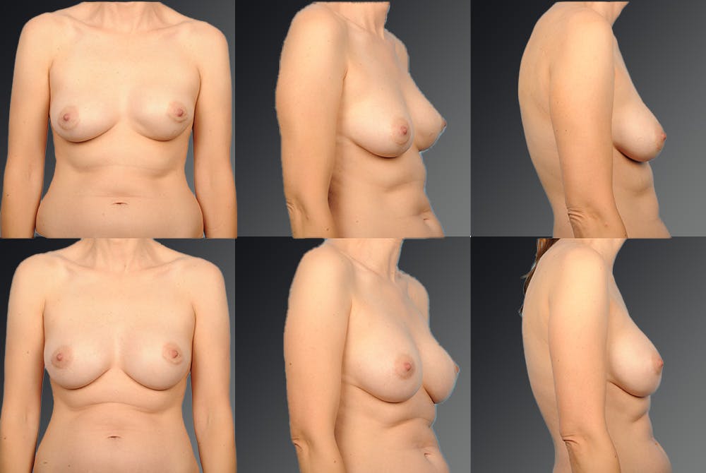 Breast Implant Revision Before & After Gallery - Patient 105516265 - Image 1