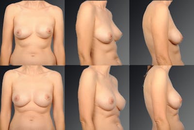 Breast Implant Revision Before & After Gallery - Patient 105516265 - Image 1