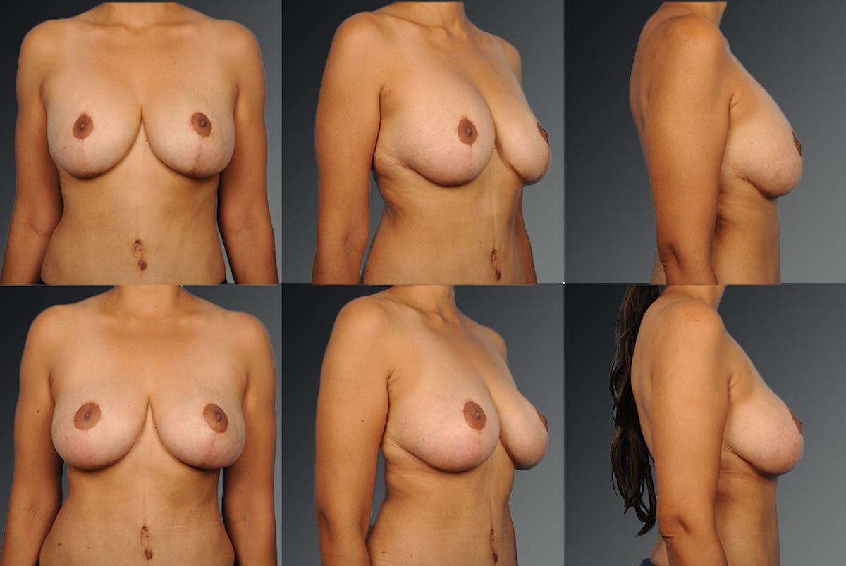 Breast Implant Revision Before & After Gallery - Patient 105516289 - Image 1