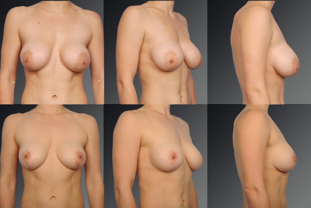 Breast Implant Revision Before & After Gallery - Patient 105516291 - Image 1
