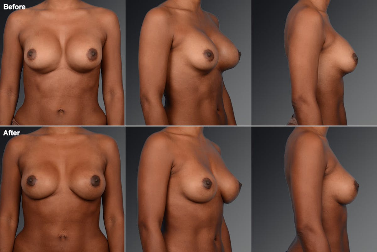 Breast Implant Revision Before & After Gallery - Patient 105516302 - Image 1