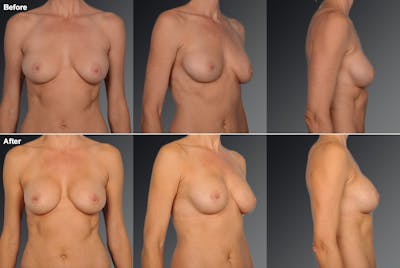 Breast Implant Revision Before & After Gallery - Patient 105516334 - Image 1
