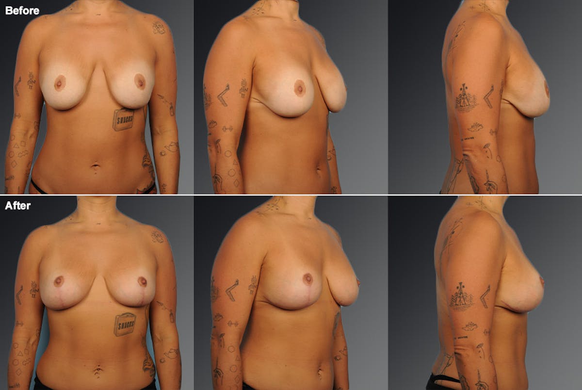 Breast Implant Revision Before & After Gallery - Patient 105516335 - Image 1