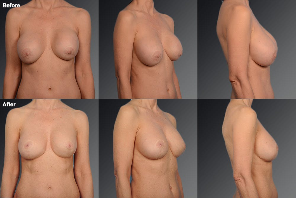 Breast Implant Revision Before & After Gallery - Patient 105516336 - Image 1