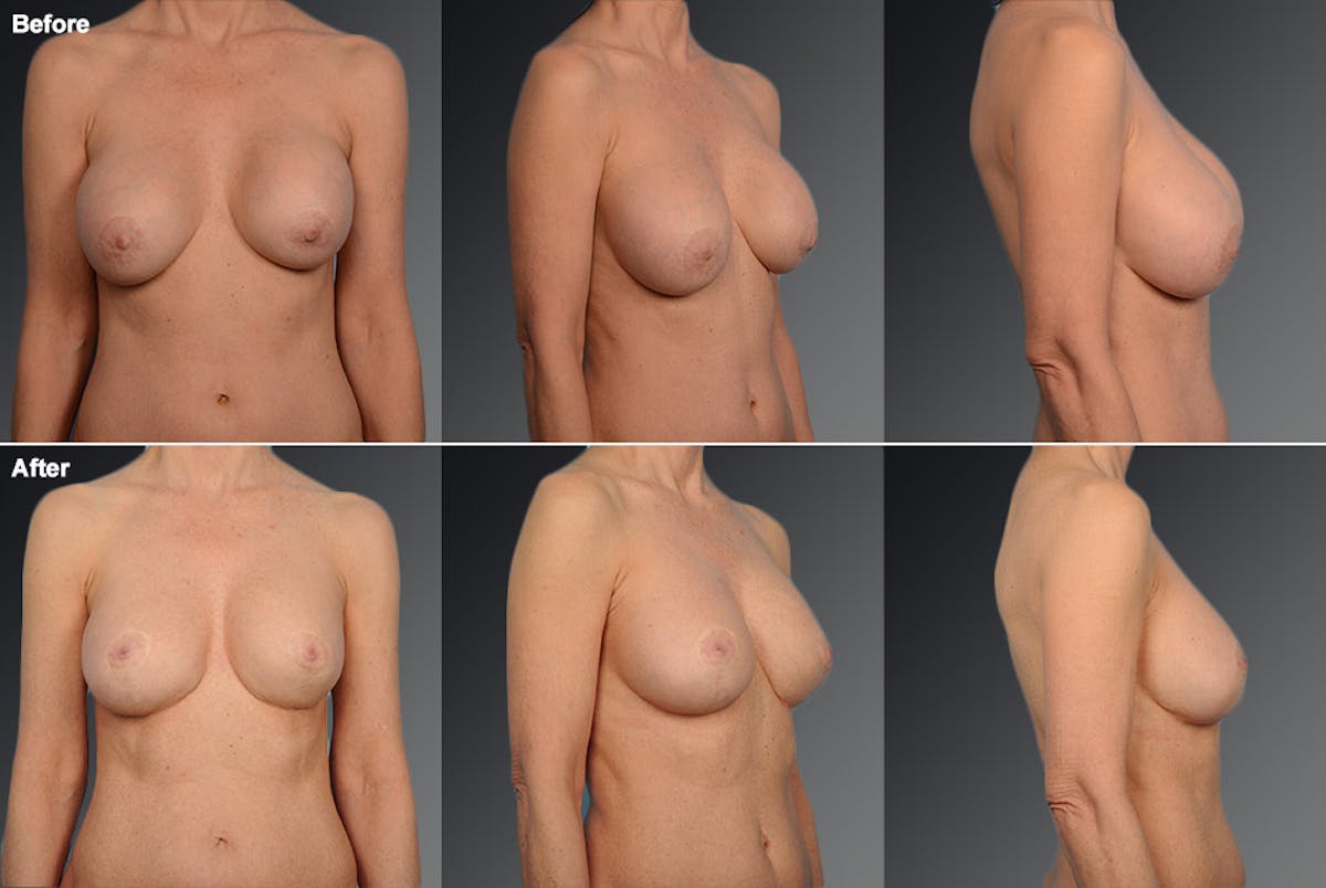 Breast Implant Revision Before & After Gallery - Patient 105516336 - Image 1