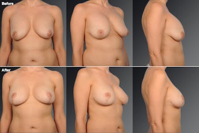 Breast Implant Revision Before & After Gallery - Patient 105534225 - Image 1