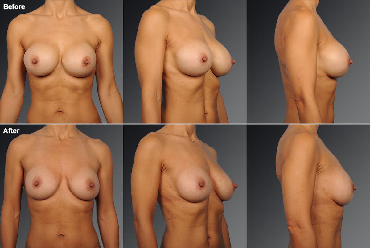 Breast Implant Revision Before & After Gallery - Patient 105534226 - Image 1