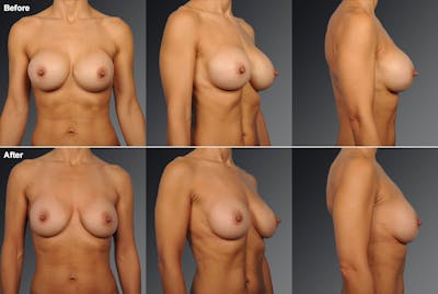 Breast Implant Revision Before & After Gallery - Patient 105534226 - Image 1