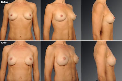 Breast Implant Revision Before & After Gallery - Patient 105534266 - Image 1