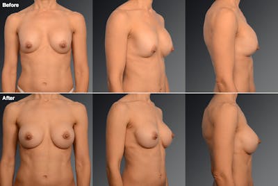 Breast Implant Revision Before & After Gallery - Patient 105534267 - Image 1