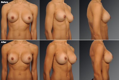 Breast Implant Revision Before & After Gallery - Patient 105534269 - Image 1