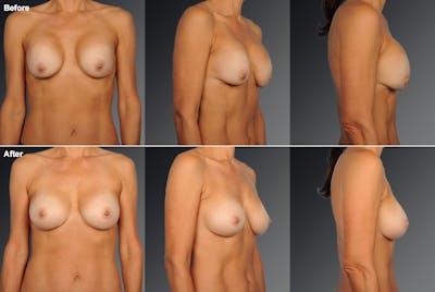 Breast Implant Revision Before & After Gallery - Patient 105534271 - Image 1