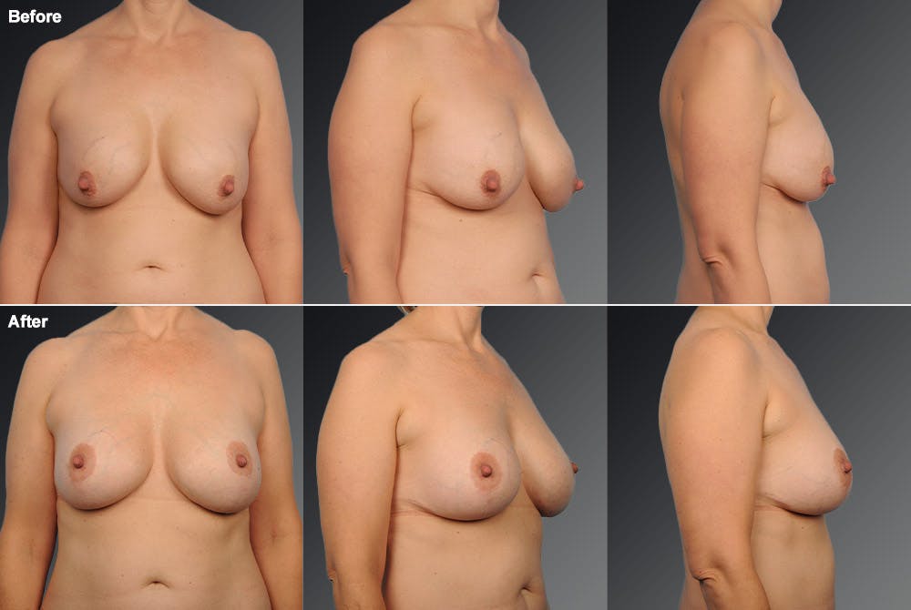 Breast Implant Revision Before & After Gallery - Patient 105534272 - Image 1