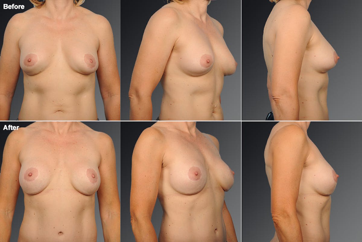 Breast Implant Revision Before & After Gallery - Patient 105534273 - Image 1