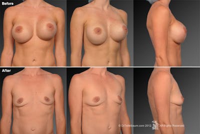 Breast Implant Revision Before & After Gallery - Patient 105534274 - Image 1