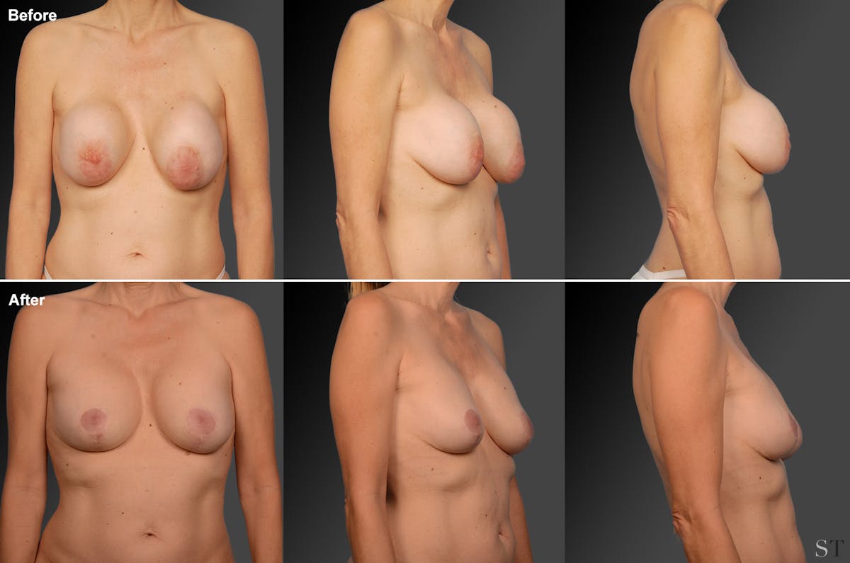 Breast Implant Revision Before & After Gallery - Patient 105534275 - Image 1