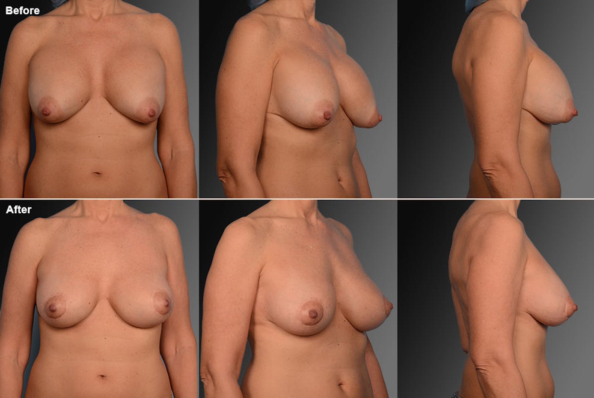 Breast Implant Revision Before & After Gallery - Patient 105534276 - Image 1