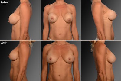 Breast Implant Revision Before & After Gallery - Patient 105534277 - Image 1