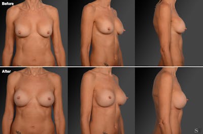 Breast Implant Revision Before & After Gallery - Patient 105534294 - Image 1