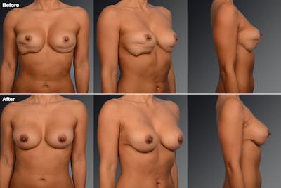 Breast Implant Revision Before & After Gallery - Patient 105534308 - Image 1