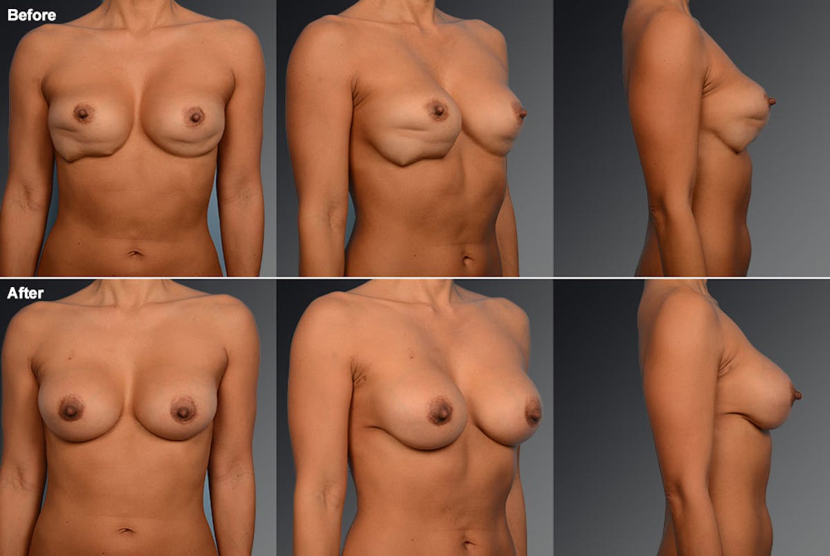 Breast Implant Revision Before & After Gallery - Patient 105534308 - Image 1
