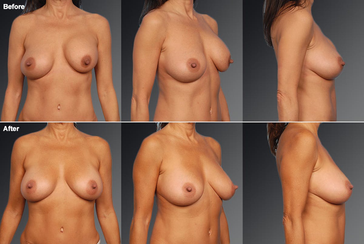 Breast Implant Revision Before & After Gallery - Patient 105534314 - Image 1