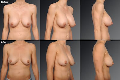 Breast Implant Revision Before & After Gallery - Patient 105534315 - Image 1