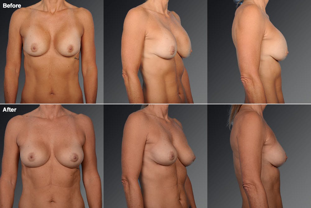Breast Implant Revision Before & After Gallery - Patient 105534316 - Image 1