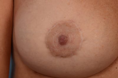 Breast Implant Revision Before & After Gallery - Patient 105534317 - Image 1