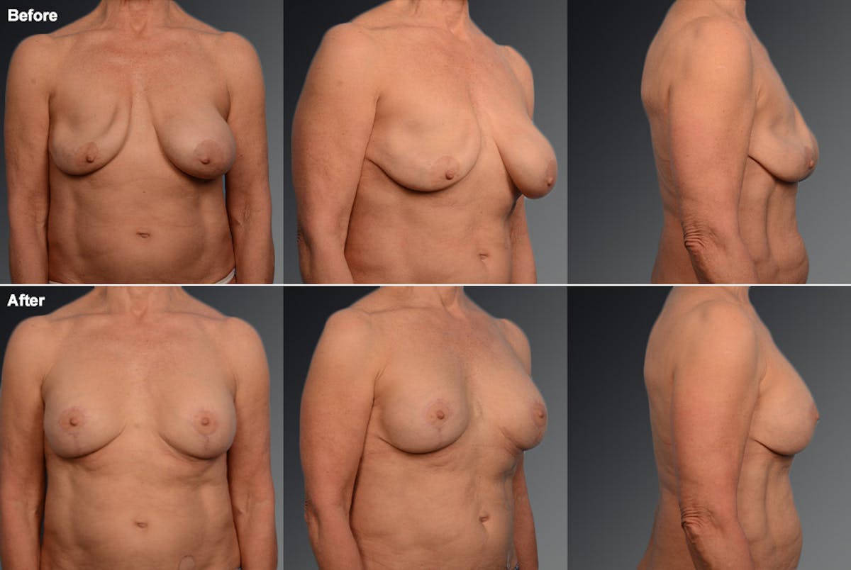 Breast Implant Revision Before & After Gallery - Patient 105534327 - Image 1