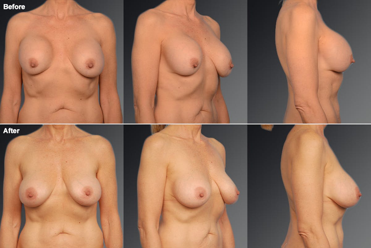 Breast Implant Revision Before & After Gallery - Patient 105534335 - Image 1