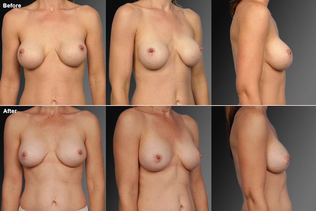 Breast Implant Revision Before & After Gallery - Patient 105534338 - Image 1