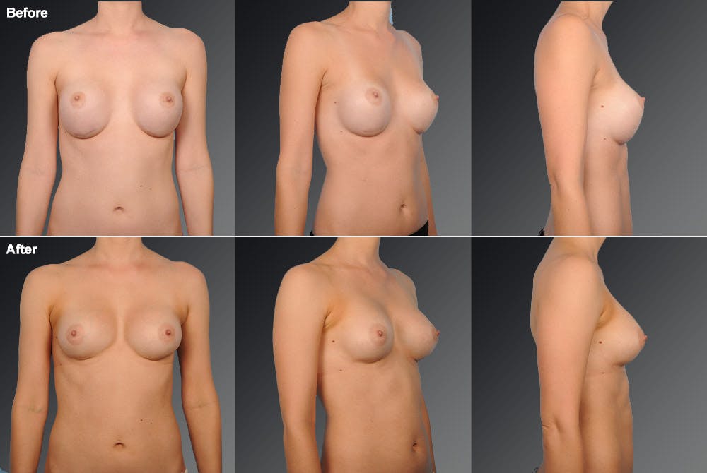 Breast Implant Revision Before & After Gallery - Patient 105534342 - Image 1